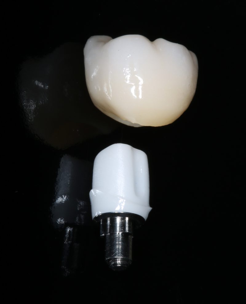 Zirconia post and core — metal free dental post